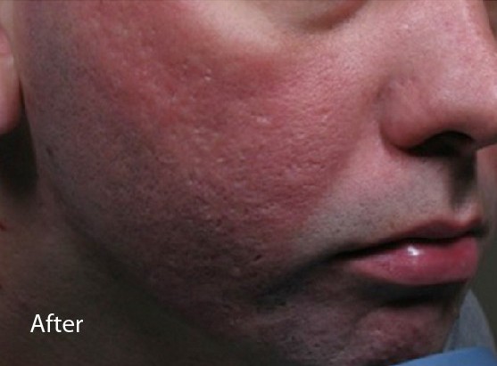 After eCO2 laser treatment - 