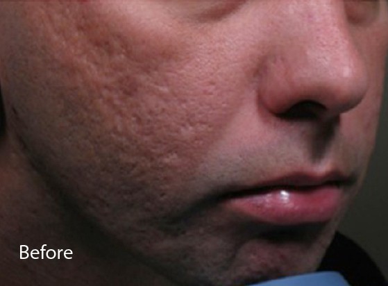Before eCO2 laser treatment - 